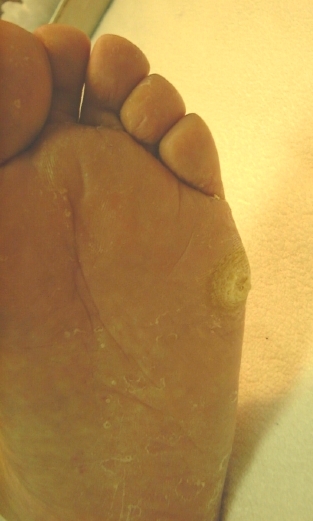Pictures of Bunion and Call Us